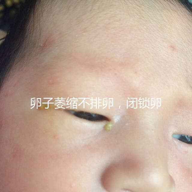 卵子萎縮不排卵，閉鎖卵泡形成原因與這4點有關