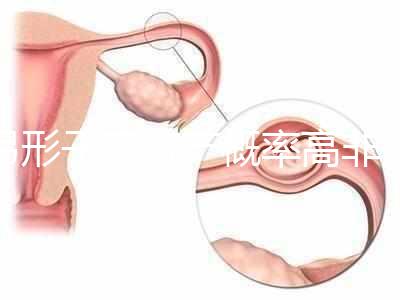 弓形子宮流產概率高非個例！罪魁禍首是這個原因