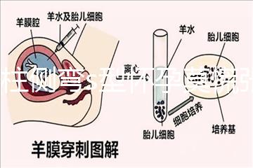 脊柱側彎s型懷孕莫慌張,能否順產還得看這4大要素